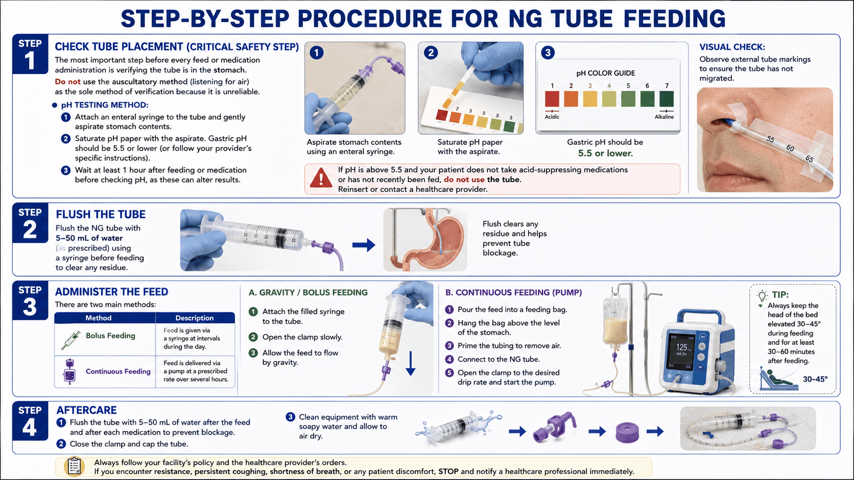 Step-by-Step Procedure for NG Tube Feeding
